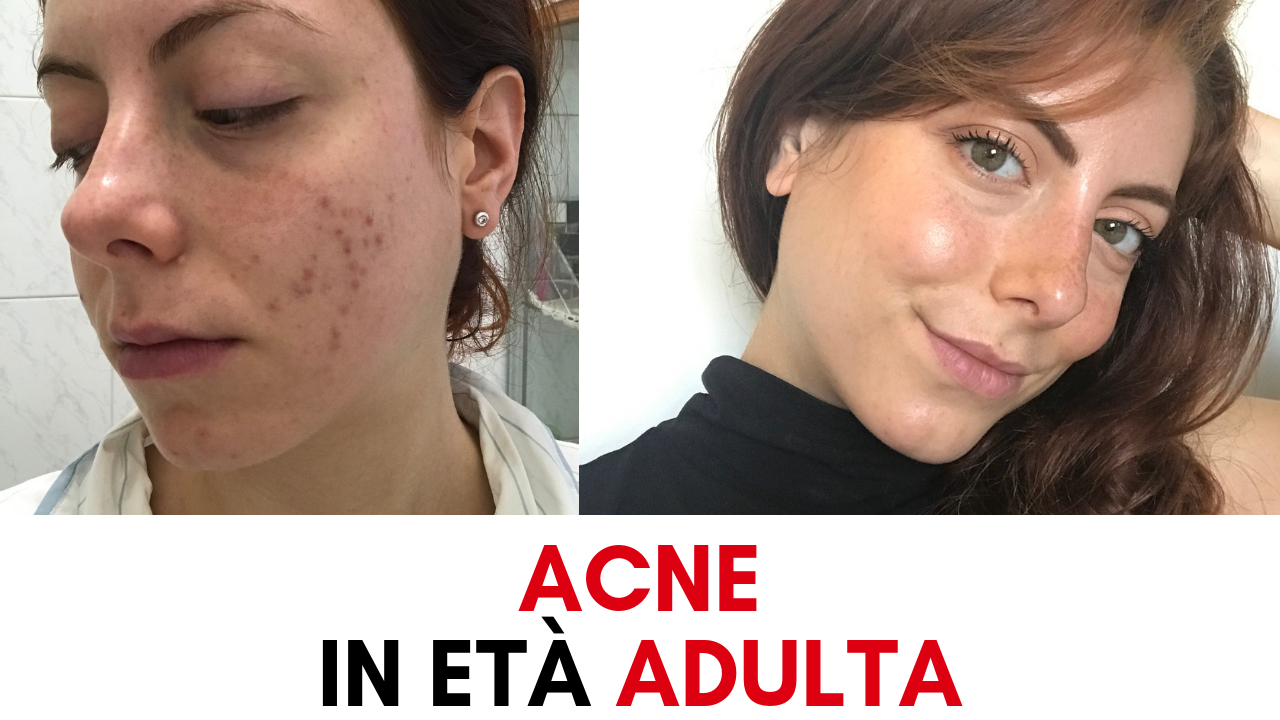 come curare l'acne in età adulta